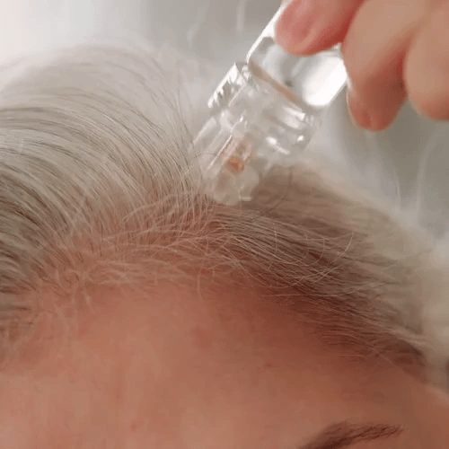 50% RABATT NUR HEUTE  Capilia™ - Regenerierende Haar-Mikroinfusion